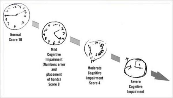ترسیم ساعت در تشخیص بیماری آلزایمر چه نقشی دارد؟